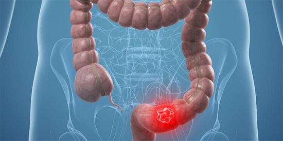 el caf� previene el c�ncer de colon